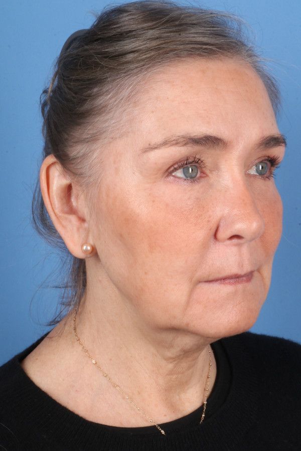 Facelift Before & After Image