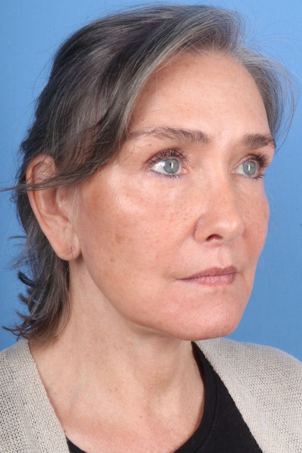 Facelift Before & After Image