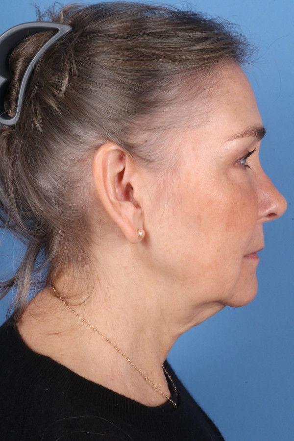 Facelift Before & After Image