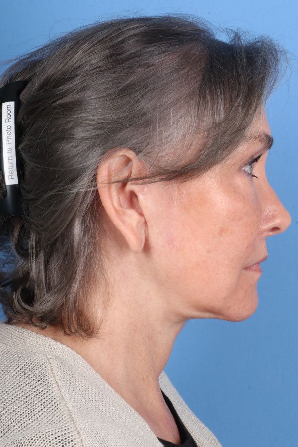 Facelift Before & After Image