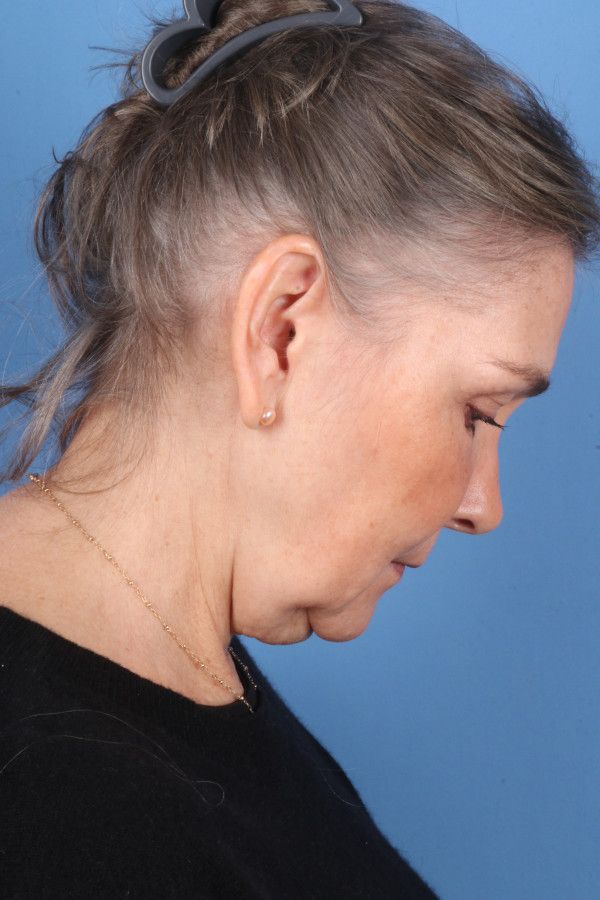 Facelift Before & After Image