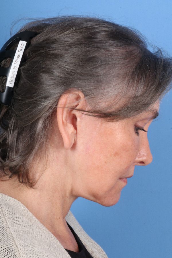 Facelift Before & After Image