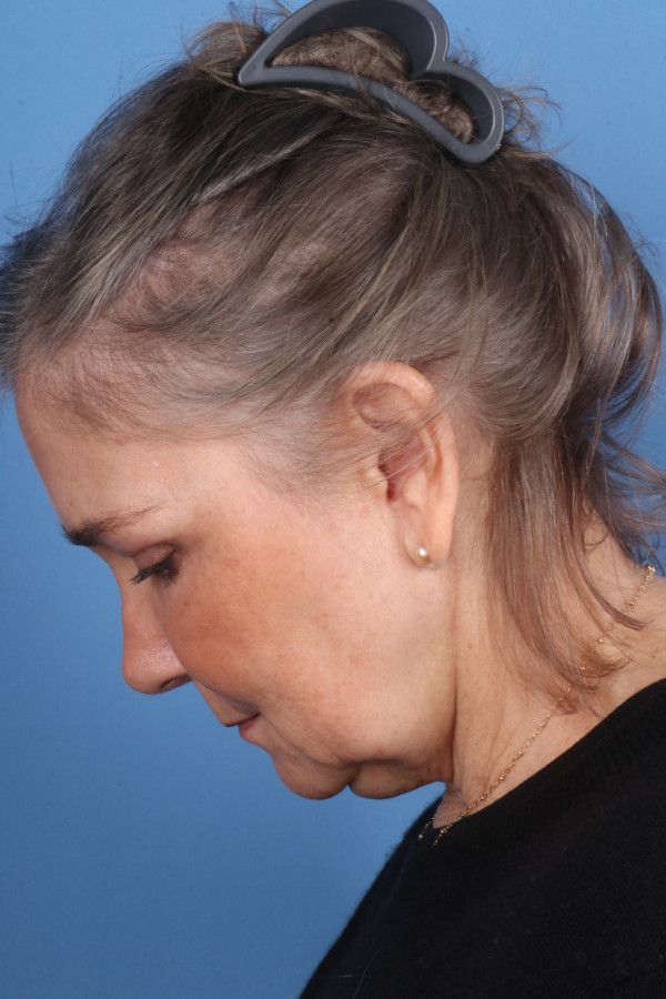 Facelift Before & After Image