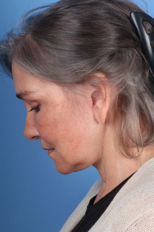 Facelift Before & After Image