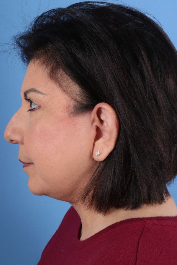 Facelift Before & After Image