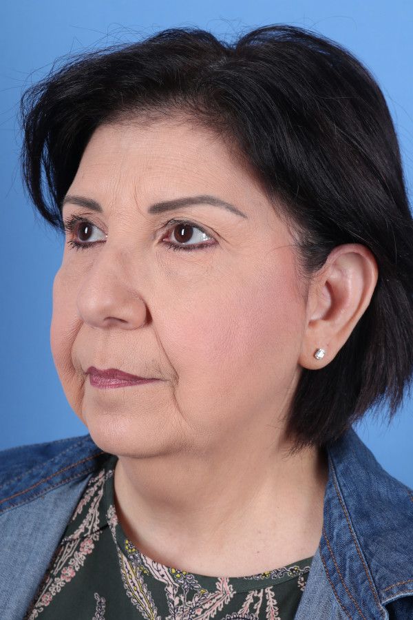 Facelift Before & After Image