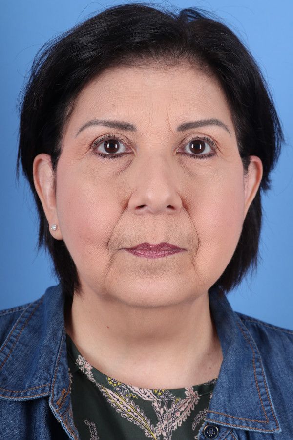 Facelift Before & After Image