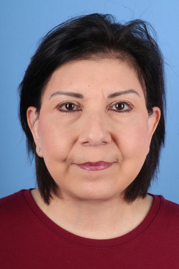 Facelift Before & After Image