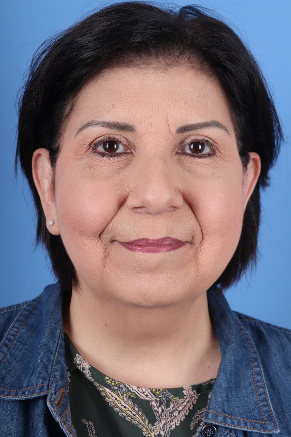 Facelift Before & After Image