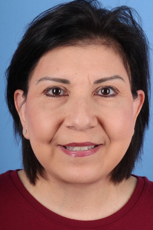 Facelift Before & After Image