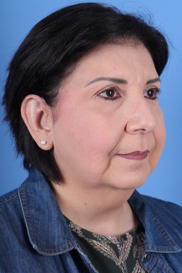 Facelift Before & After Image