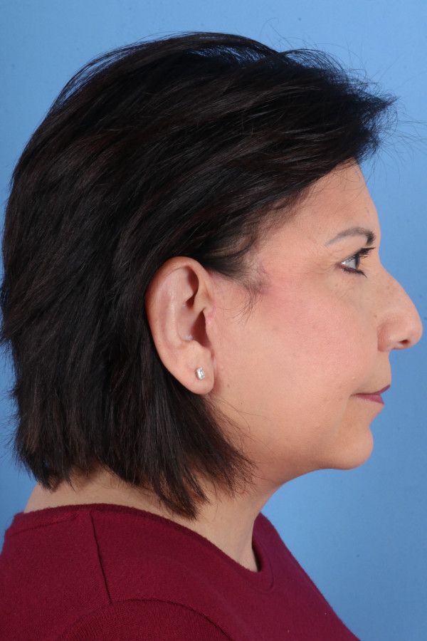 Facelift Before & After Image