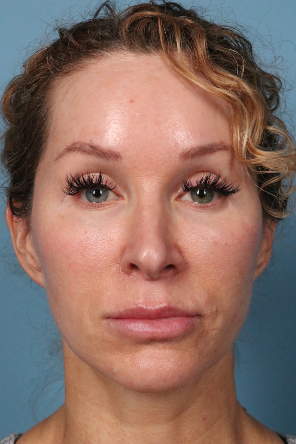 Lip Lift Before & After Image