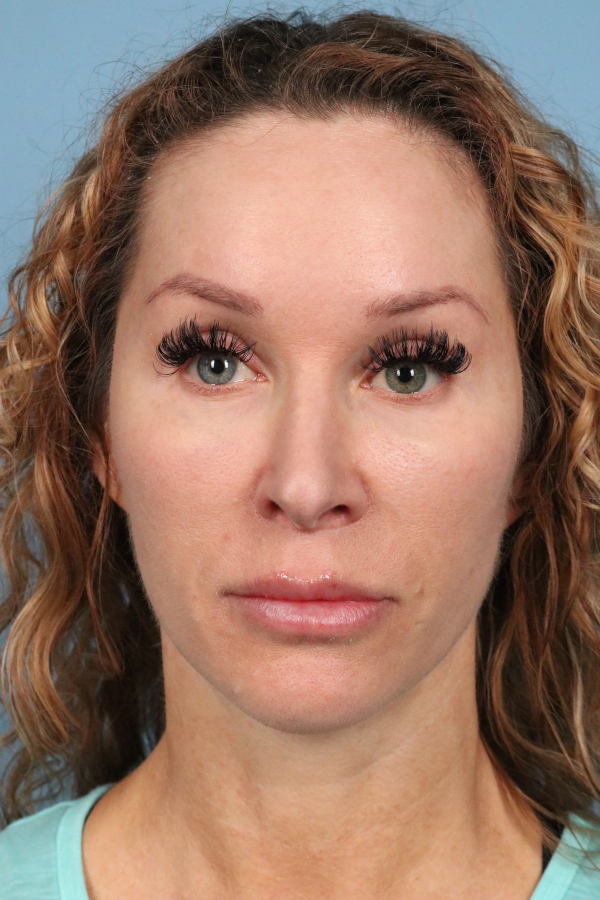 Lip Lift Before & After Image