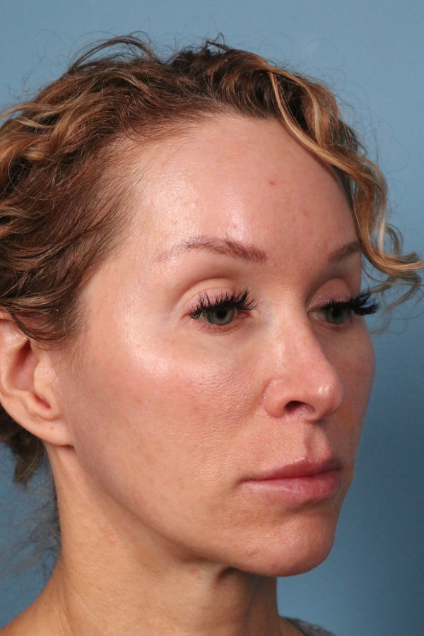 Lip Lift Before & After Image