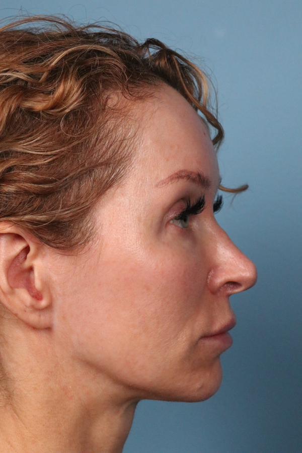 Lip Lift Before & After Image