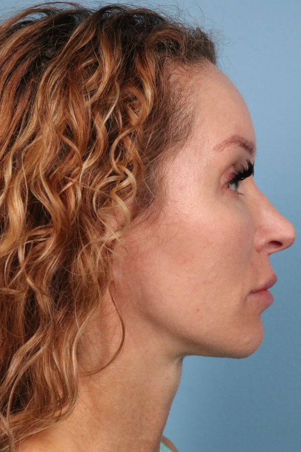 Lip Lift Before & After Image