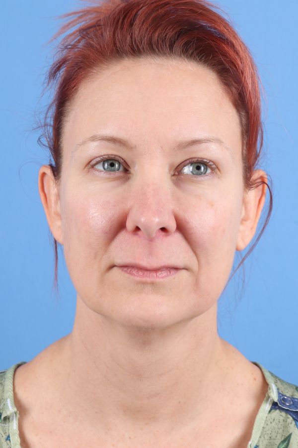 Lip Lift Before & After Image