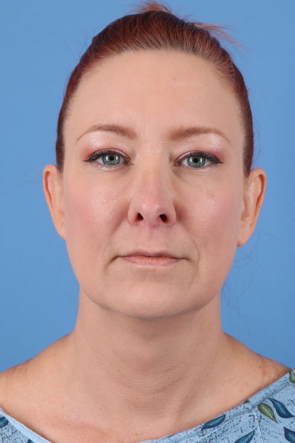 Lip Lift Before & After Image