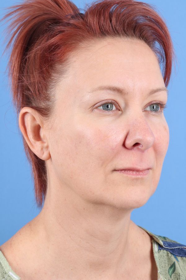 Lip Lift Before & After Image