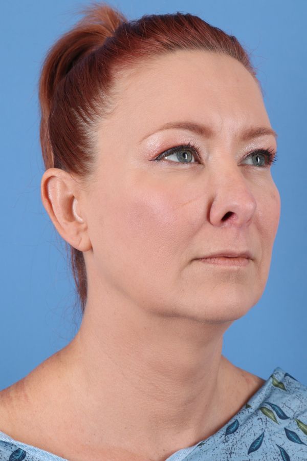 Lip Lift Before & After Image