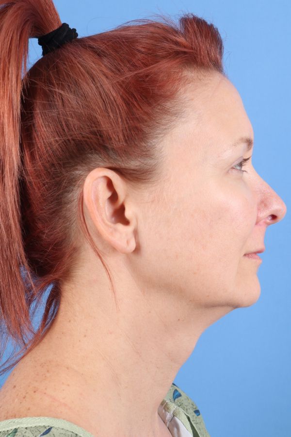 Lip Lift Before & After Image