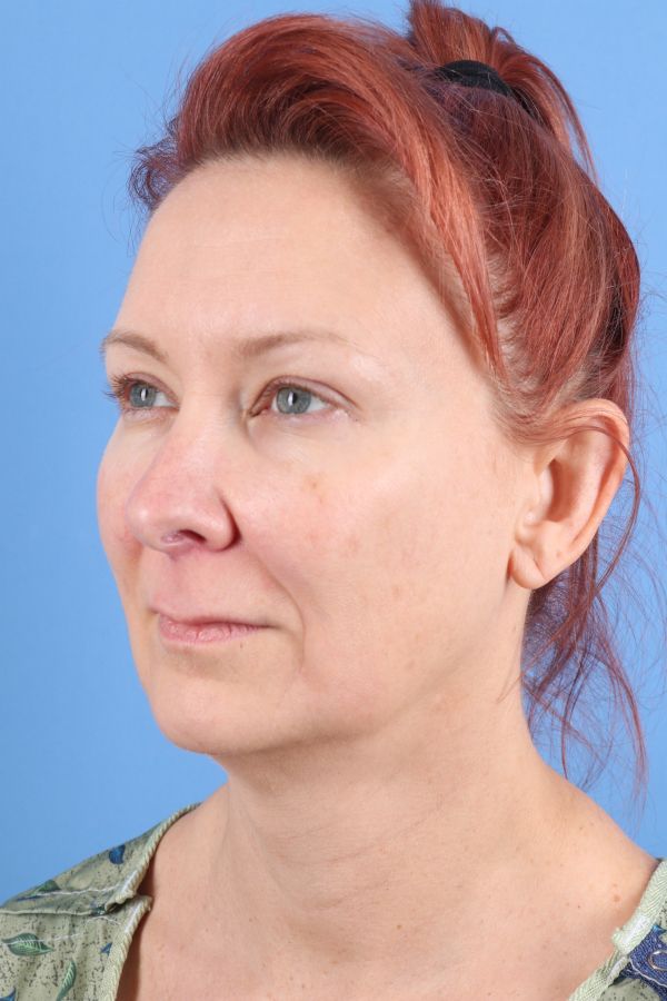Lip Lift Before & After Image