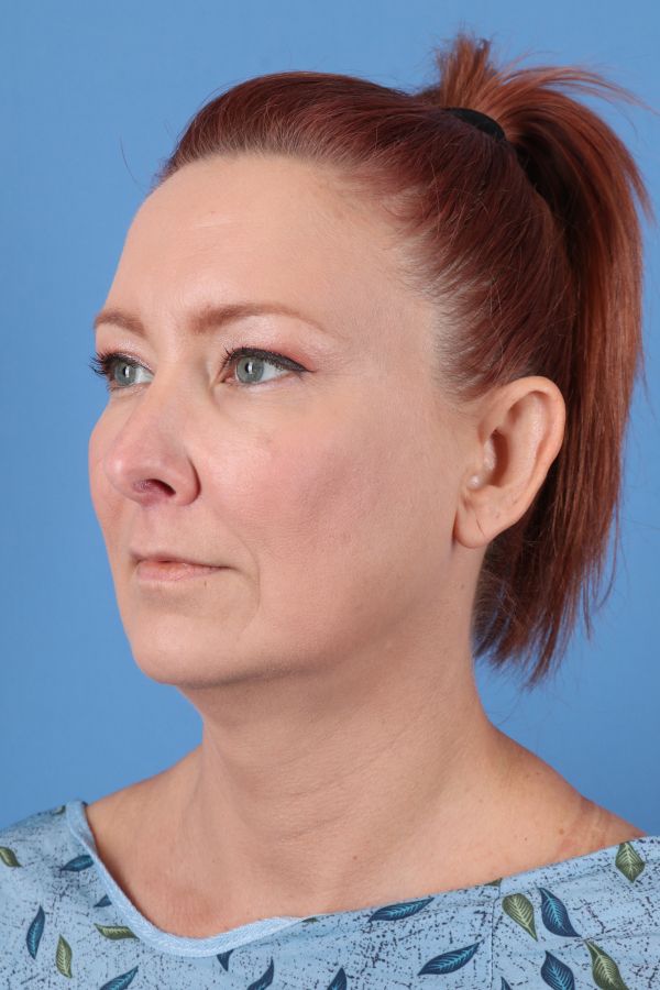 Lip Lift Before & After Image