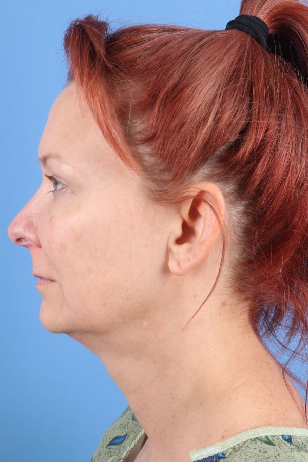 Lip Lift Before & After Image