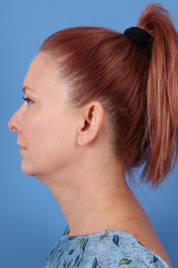 Lip Lift Before & After Image