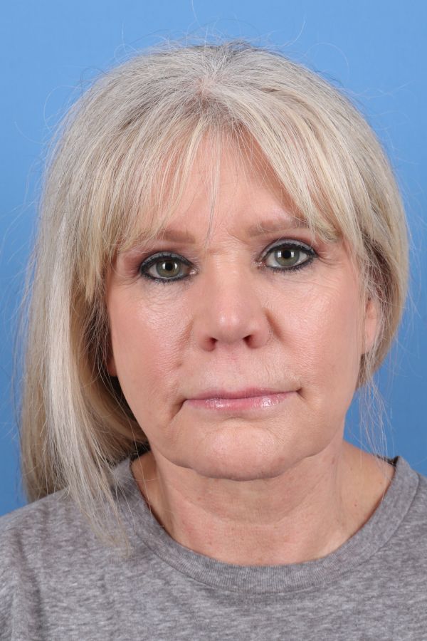 Lip lift Before & After Image