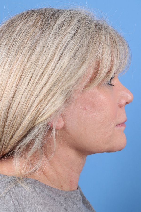 Lip Lift Before & After Image