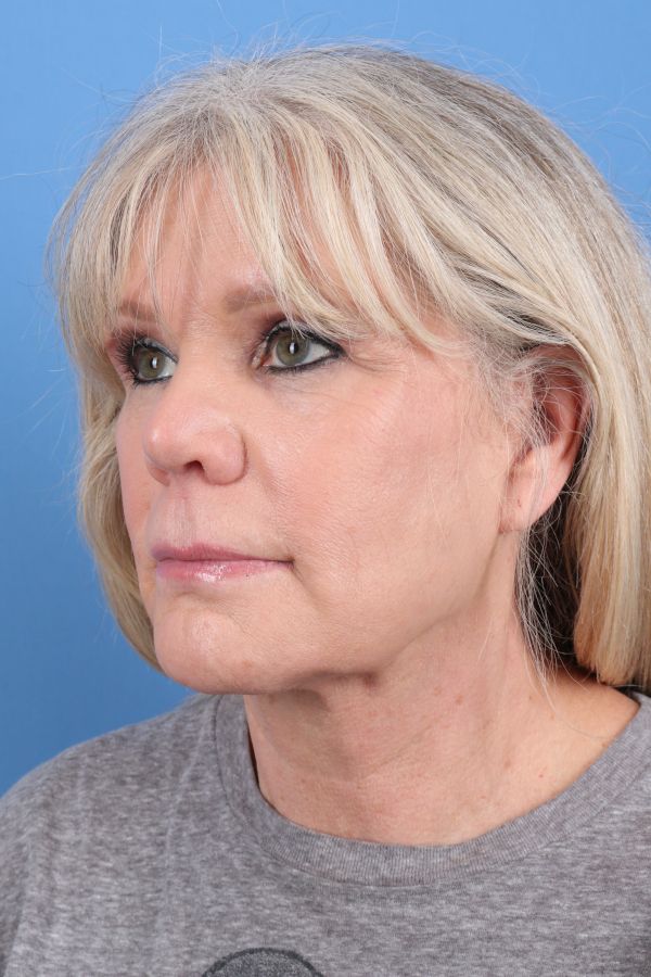 Lip Lift Before & After Image