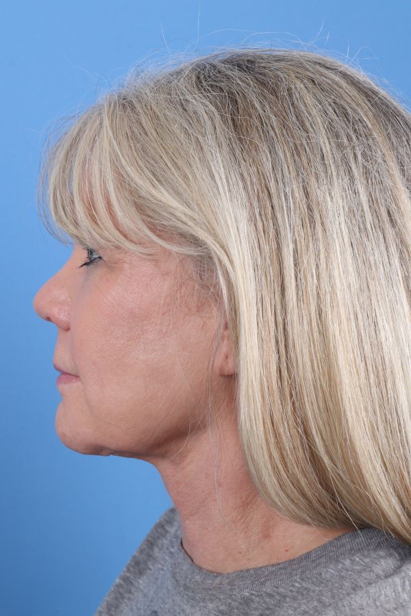 Lip Lift Before & After Image