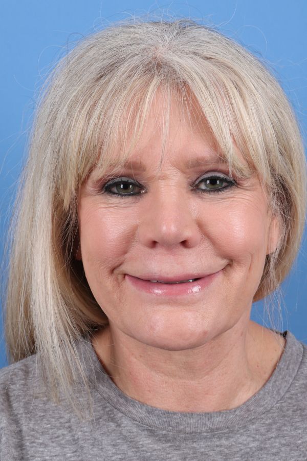 Lip Lift Before & After Image