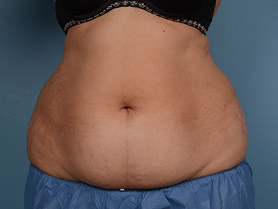 CoolSculpting® Before & After Image