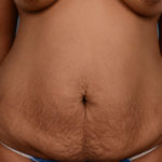 Tummy Tuck Before & After Patient #1263