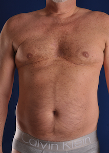 Vaser Liposuction Before & After Patient #2233