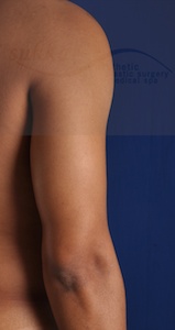Vaser Liposuction Before & After Patient #2236
