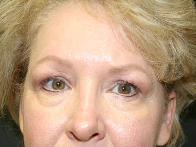 Brow Lift Before & After Patient #2260