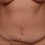 Tummy Tuck Before & After Patient #1384