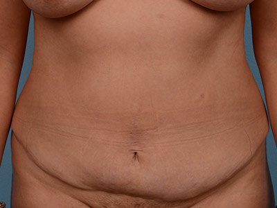 Tummy Tuck Before & After Patient #1384