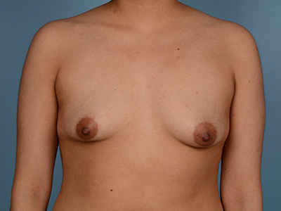 Breast Augmentation Before & After Patient #2381