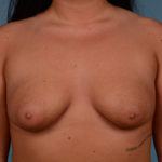 Breast Augmentation Before & After Patient #2418