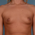 Breast Augmentation Before & After Patient #2426