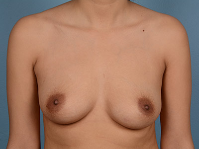 Breast Augmentation Before & After Patient #2436