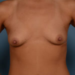 Breast Augmentation Before & After Patient #2568