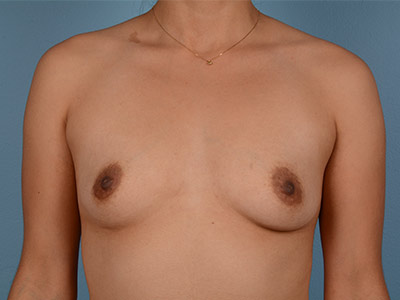 Breast Augmentation Before & After Patient #2579