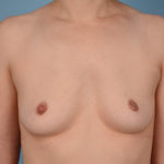 Breast Augmentation Before & After Patient #2592