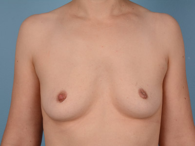 Breast Augmentation Before & After Patient #2592